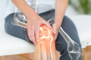 When to Consider Knee Replacement Picture